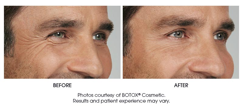 botox-results-10