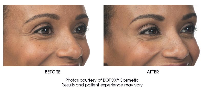 botox-results-4