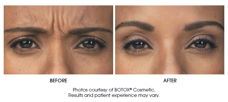 botox-results-5