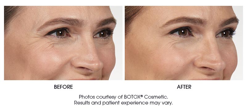botox-results-6