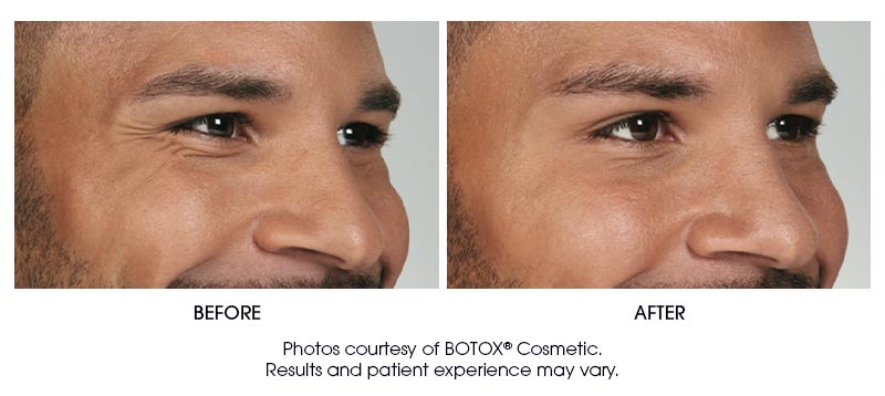 botox-results-8
