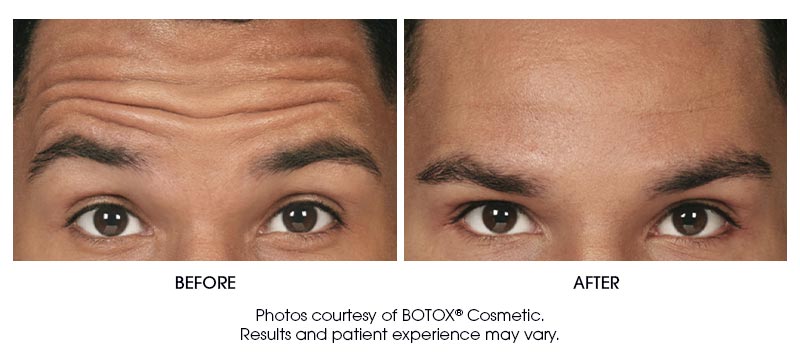 botox-results-9