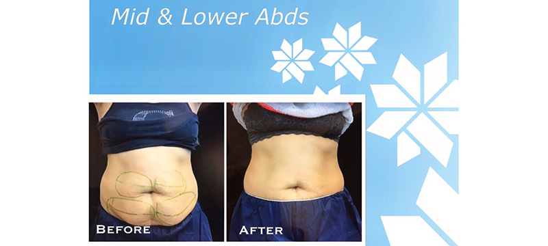 Before and After results for CoolSculpting® Elite in the mid and lower abs