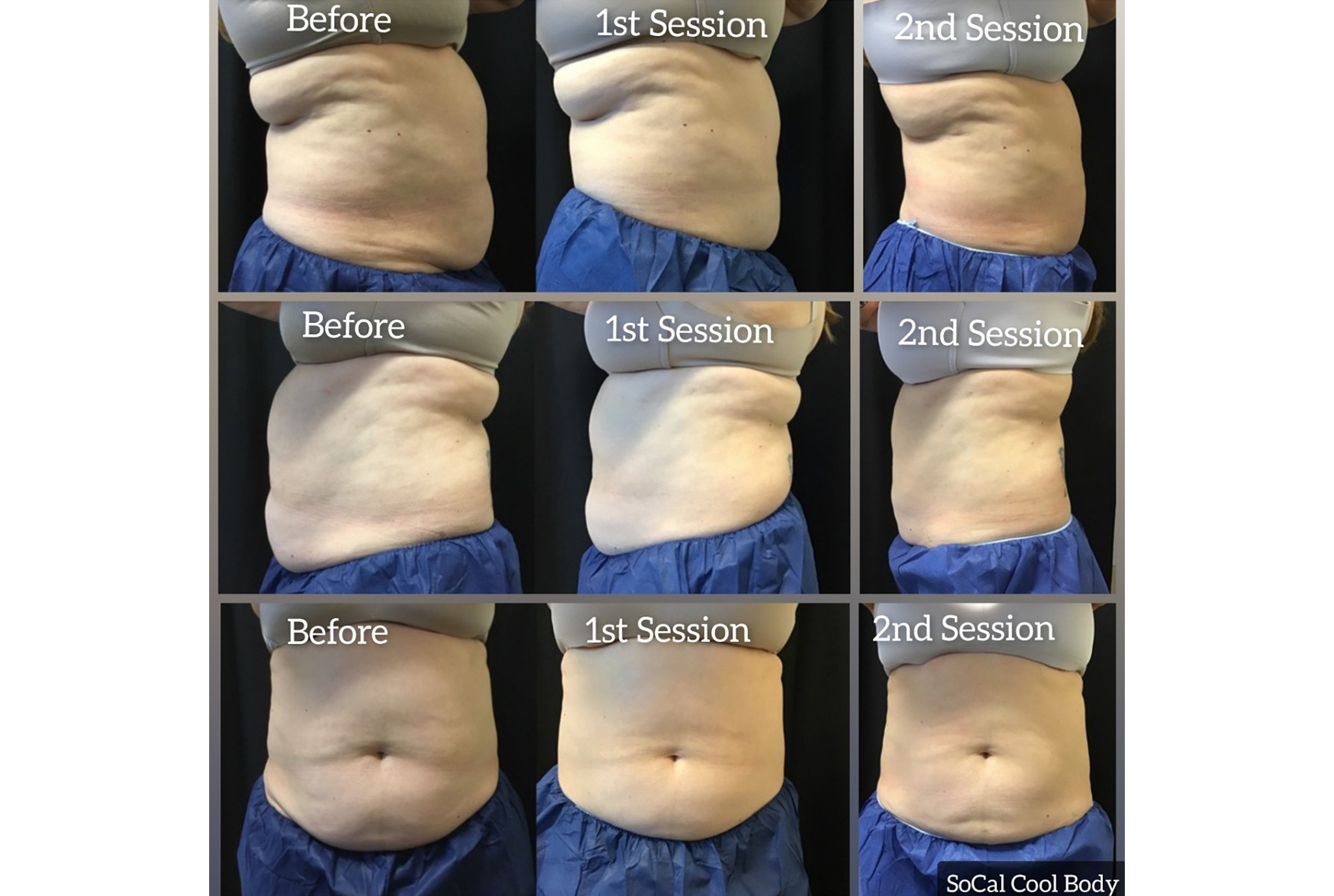 coolsculpting-after-second-session