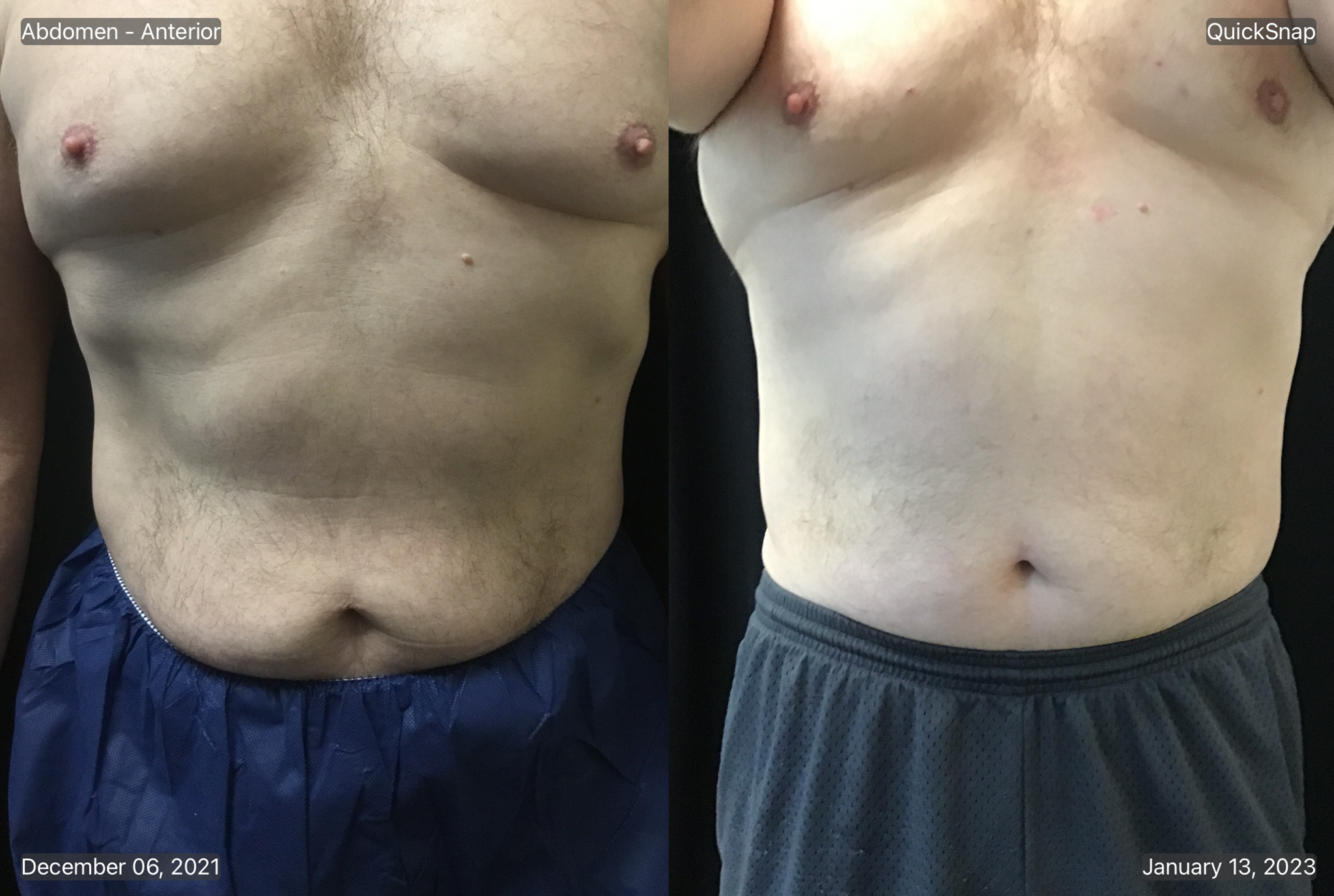 coolsculpting-belly-before-and-after