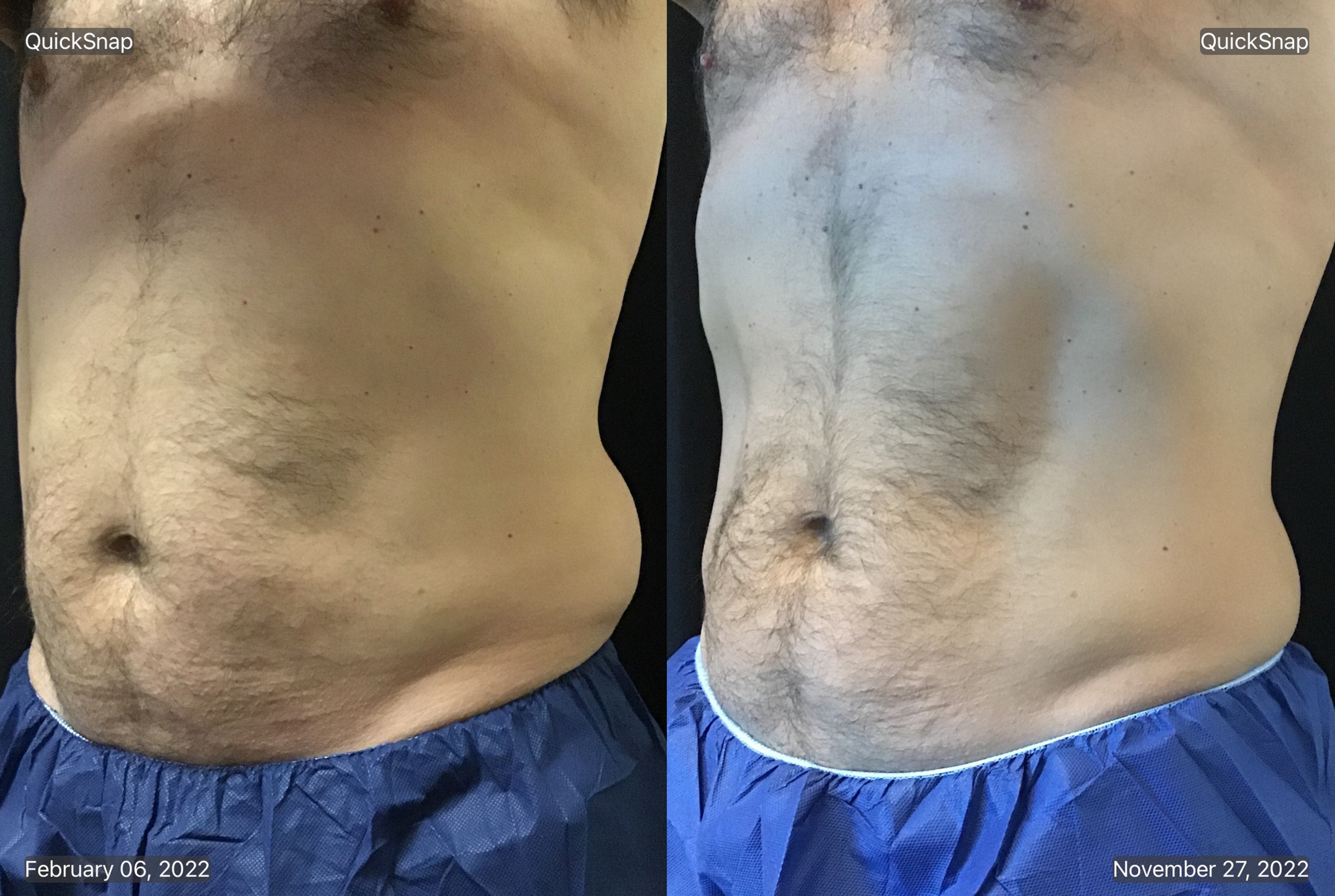 coolsculpting-abdomen-before-and-after-photo