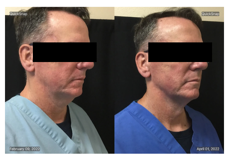 coolsculpting-chin-palm-springs-ca